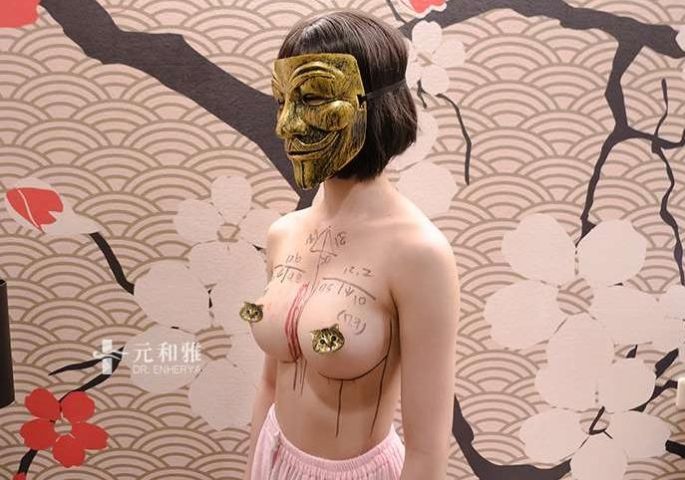 Motiva魔滴隆乳手術失敗重做案例分享2.0石頭奶貫穿奶二次隆乳元和雅